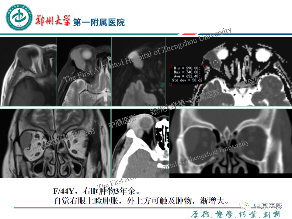 影像PPT - 【PPT】眼眶淋巴瘤的MRI诊断-41