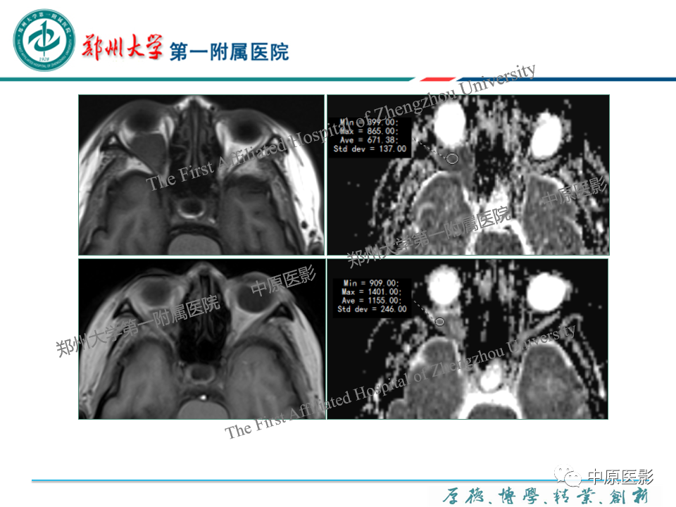 影像PPT - 【PPT】眼眶淋巴瘤的MRI诊断-38
