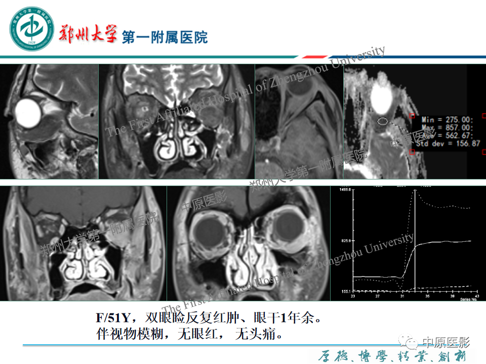 影像PPT - 【PPT】眼眶淋巴瘤的MRI诊断-55