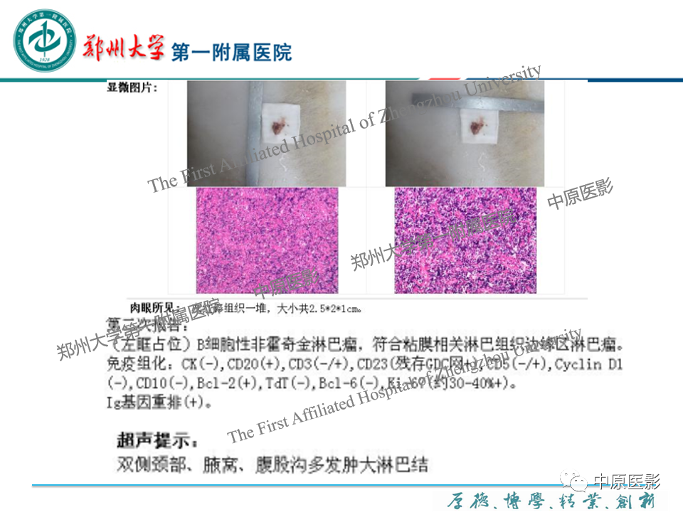 影像PPT - 【PPT】眼眶淋巴瘤的MRI诊断-57