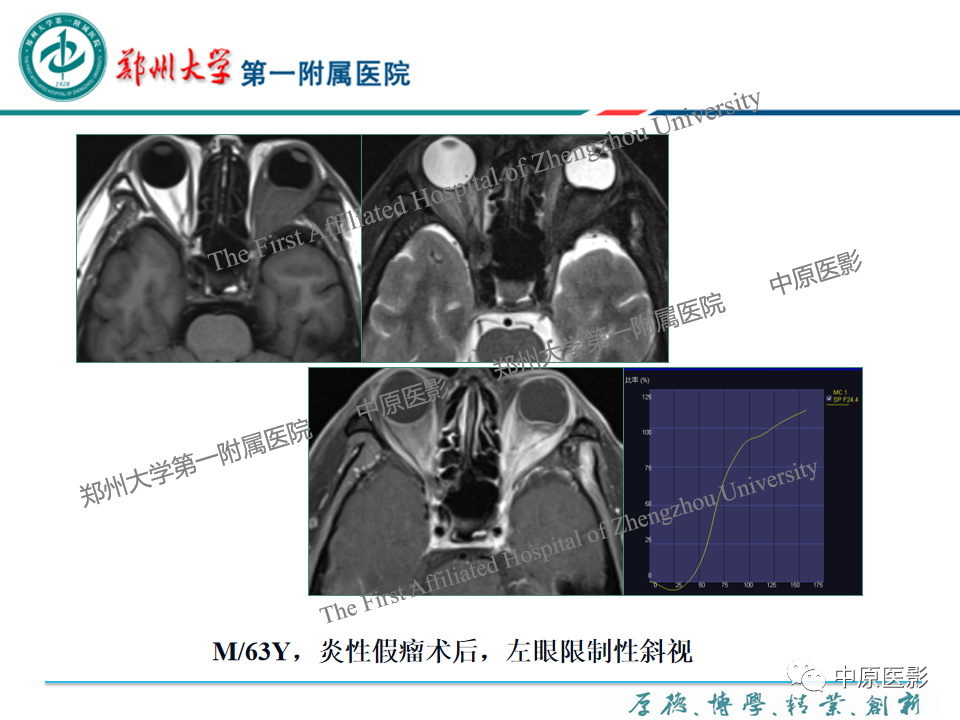 影像PPT - 【PPT】眼眶淋巴瘤的MRI诊断-65