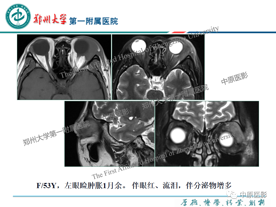 影像PPT - 【PPT】眼眶淋巴瘤的MRI诊断-66