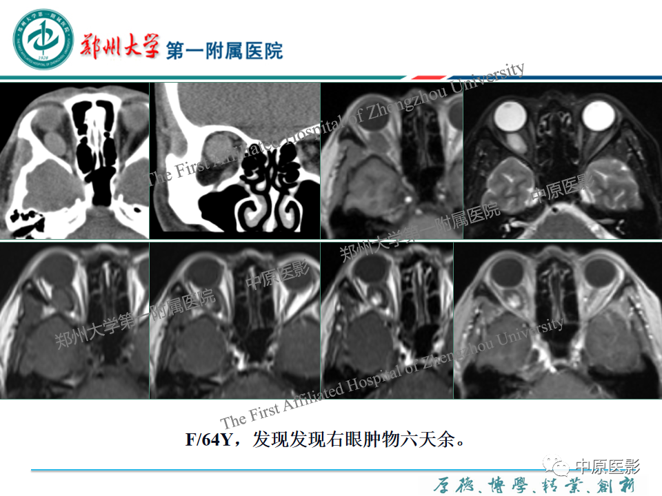 影像PPT - 【PPT】眼眶淋巴瘤的MRI诊断-68