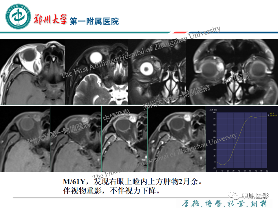 影像PPT - 【PPT】眼眶淋巴瘤的MRI诊断-69