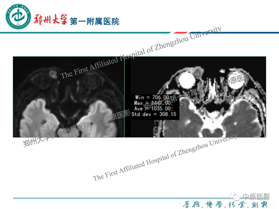 影像PPT - 【PPT】眼眶淋巴瘤的MRI诊断-70