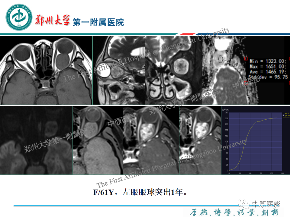 影像PPT - 【PPT】眼眶淋巴瘤的MRI诊断-72