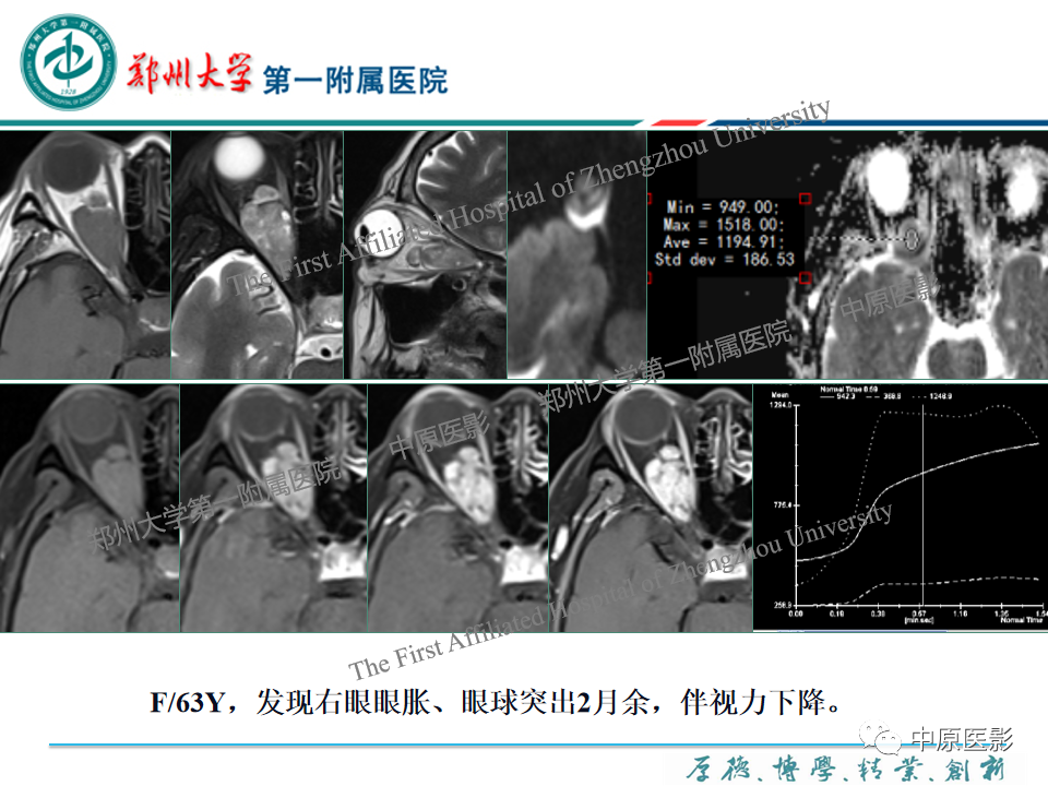 影像PPT - 【PPT】眼眶淋巴瘤的MRI诊断-73