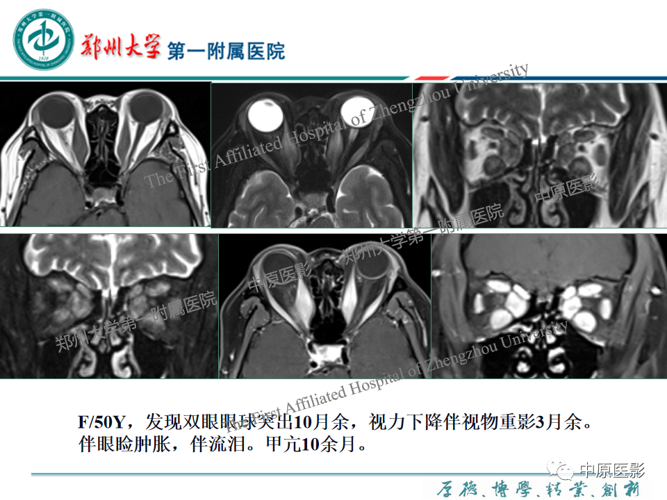 影像PPT - 【PPT】眼眶淋巴瘤的MRI诊断-75