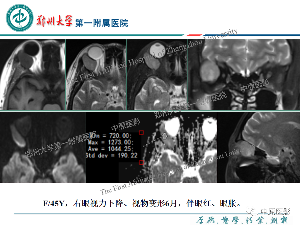 影像PPT - 【PPT】眼眶淋巴瘤的MRI诊断-77