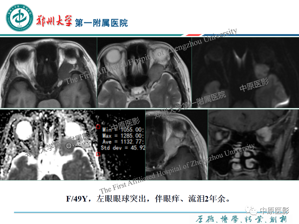 影像PPT - 【PPT】眼眶淋巴瘤的MRI诊断-78