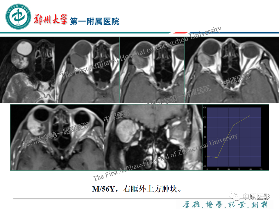 影像PPT - 【PPT】眼眶淋巴瘤的MRI诊断-80