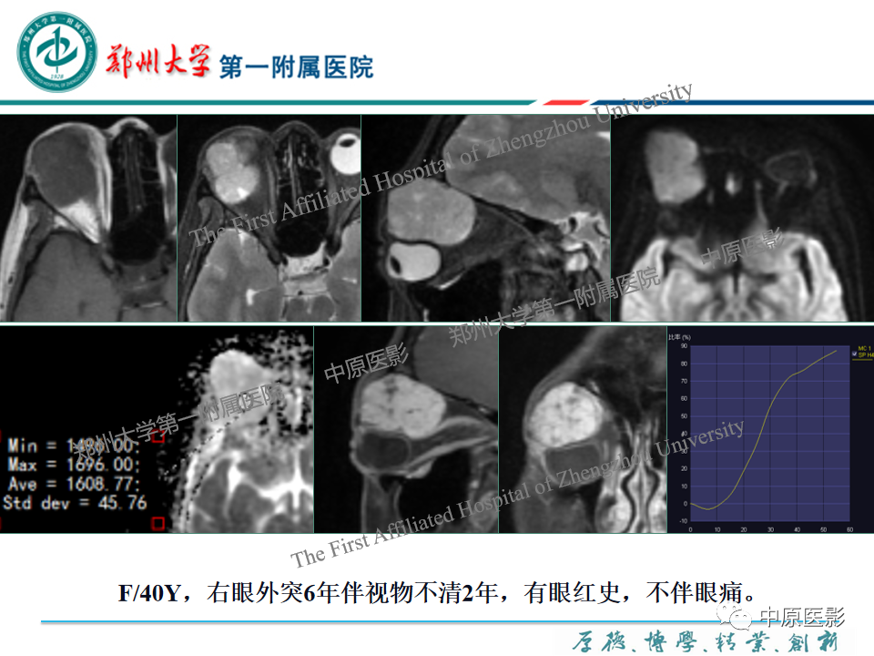 影像PPT - 【PPT】眼眶淋巴瘤的MRI诊断-81