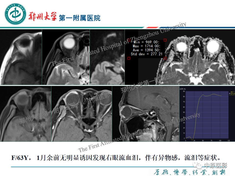 影像PPT - 【PPT】眼眶淋巴瘤的MRI诊断-83