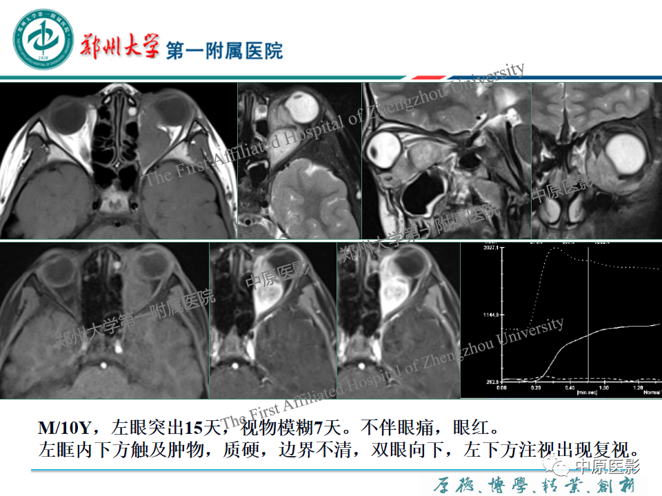 影像PPT - 【PPT】眼眶淋巴瘤的MRI诊断-86