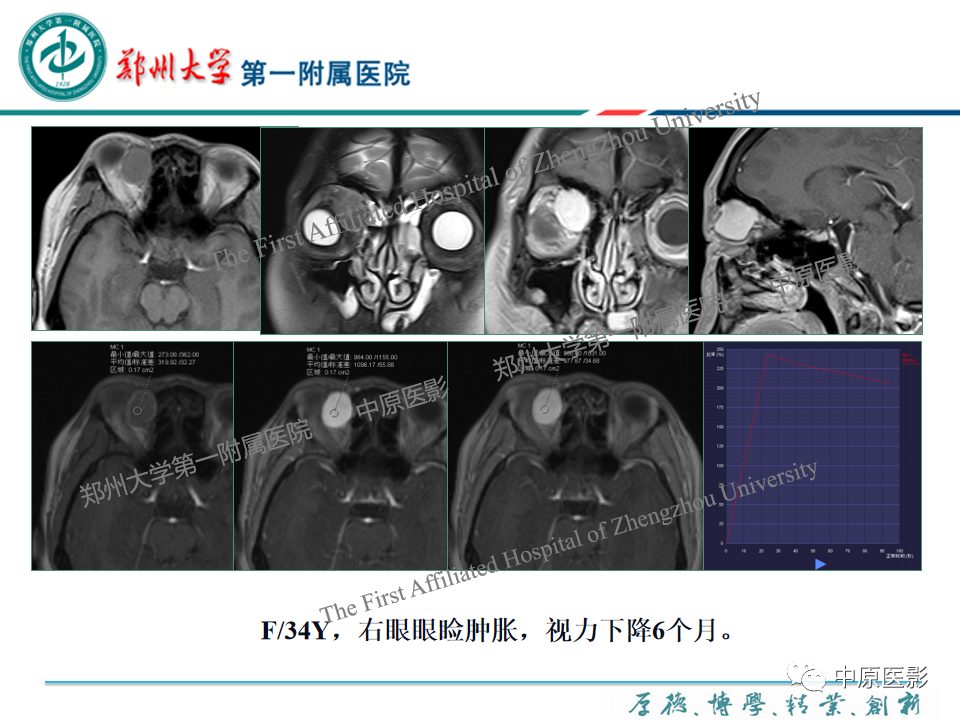 影像PPT - 【PPT】眼眶淋巴瘤的MRI诊断-88