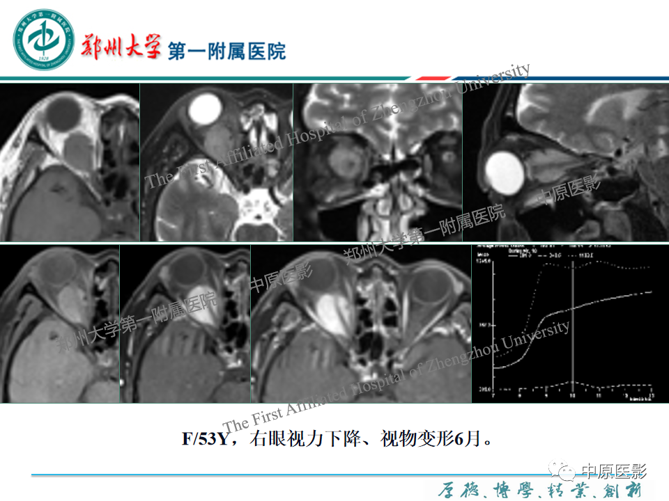 影像PPT - 【PPT】眼眶淋巴瘤的MRI诊断-90