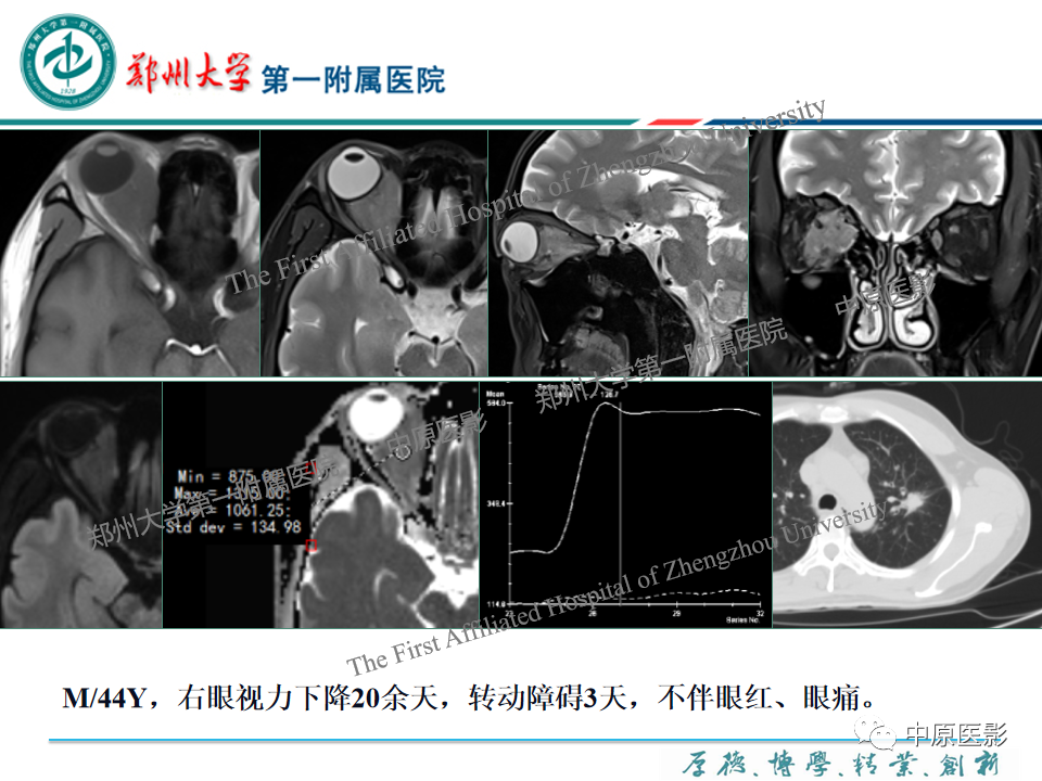 影像PPT - 【PPT】眼眶淋巴瘤的MRI诊断-93