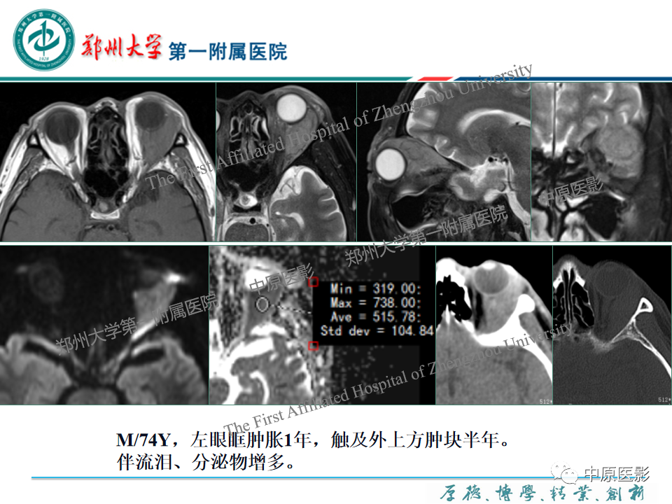 影像PPT - 【PPT】眼眶淋巴瘤的MRI诊断-95