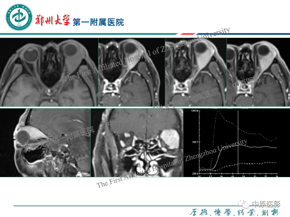 影像PPT - 【PPT】眼眶淋巴瘤的MRI诊断-96