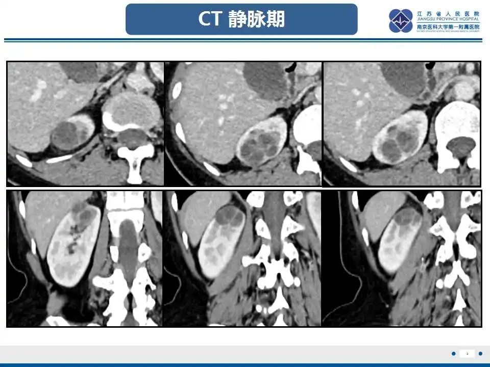 影像PPT - 【PPT】克唑替尼相关性肾囊肿-4