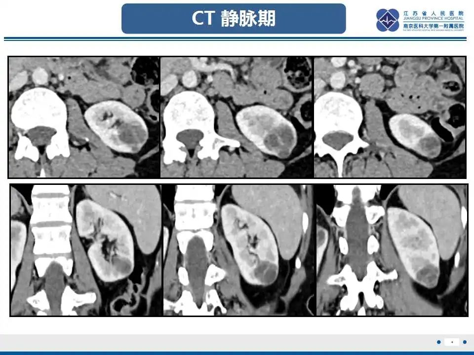 影像PPT - 【PPT】克唑替尼相关性肾囊肿-5