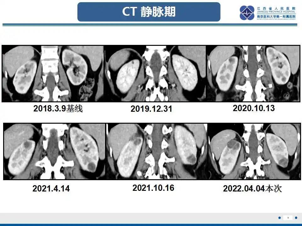 影像PPT - 【PPT】克唑替尼相关性肾囊肿-6