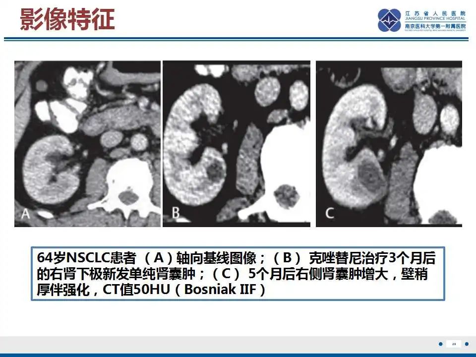 影像PPT - 【PPT】克唑替尼相关性肾囊肿-29