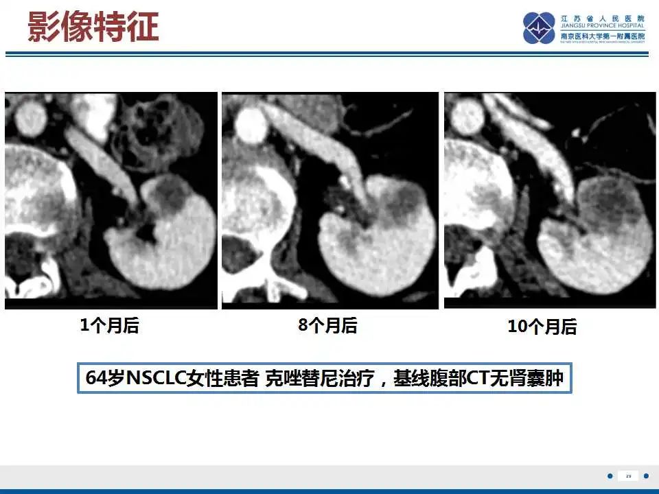 影像PPT - 【PPT】克唑替尼相关性肾囊肿-30