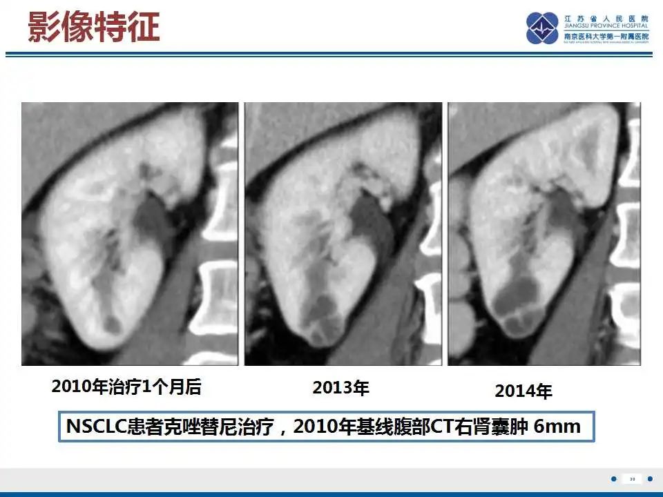 影像PPT - 【PPT】克唑替尼相关性肾囊肿-31