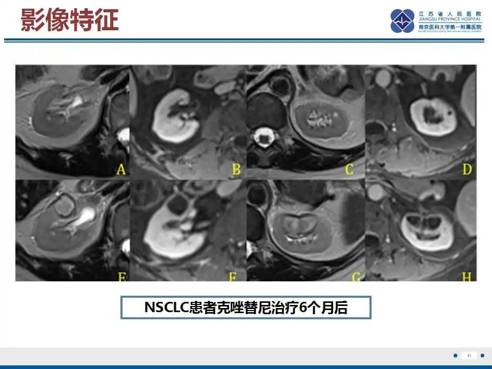 影像PPT - 【PPT】克唑替尼相关性肾囊肿-32