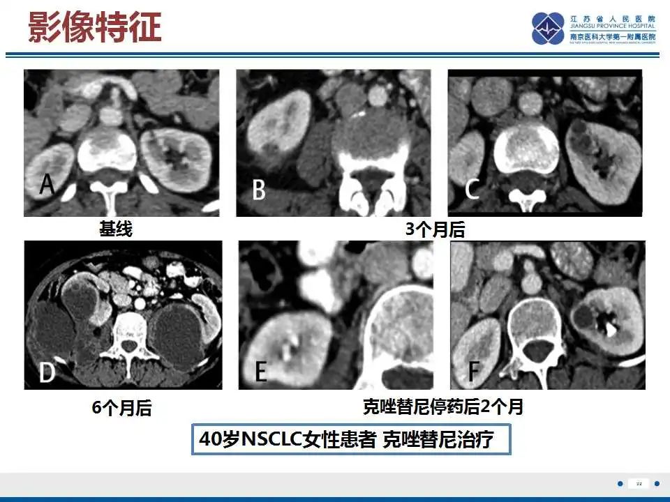 影像PPT - 【PPT】克唑替尼相关性肾囊肿-33