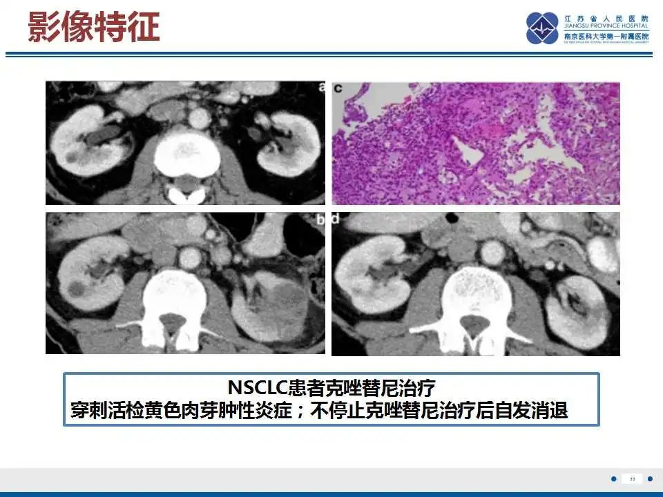 影像PPT - 【PPT】克唑替尼相关性肾囊肿-34