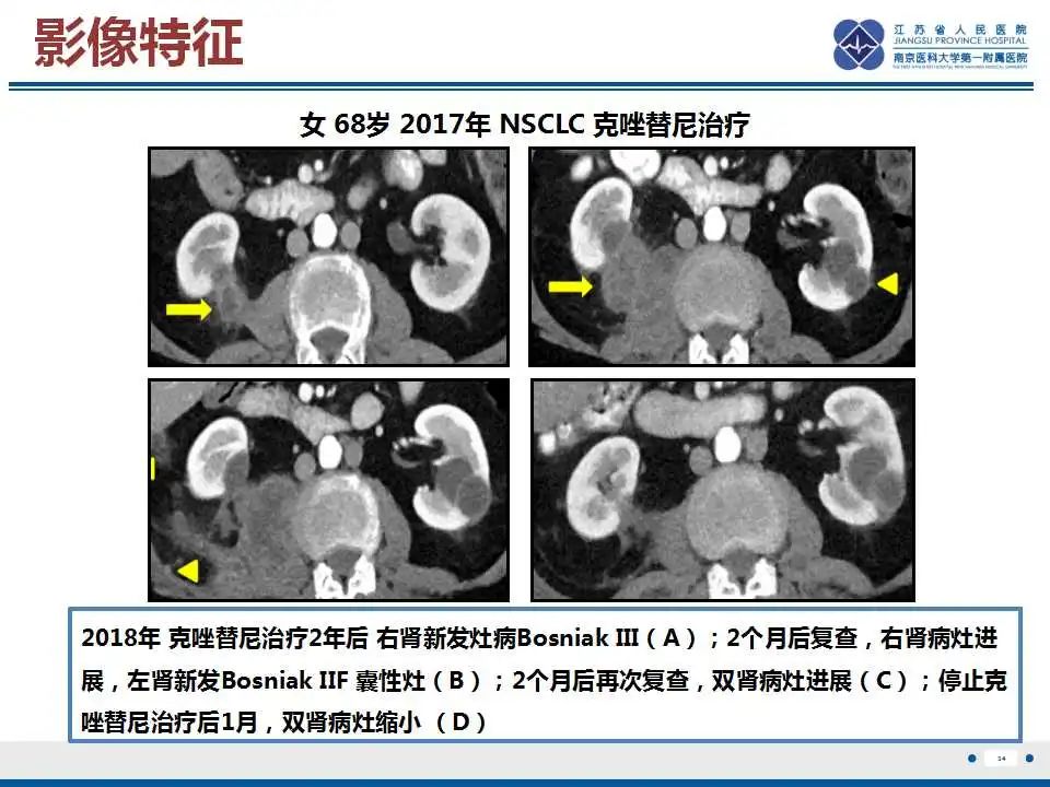 影像PPT - 【PPT】克唑替尼相关性肾囊肿-35