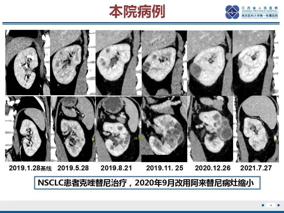 影像PPT - 【PPT】克唑替尼相关性肾囊肿-37