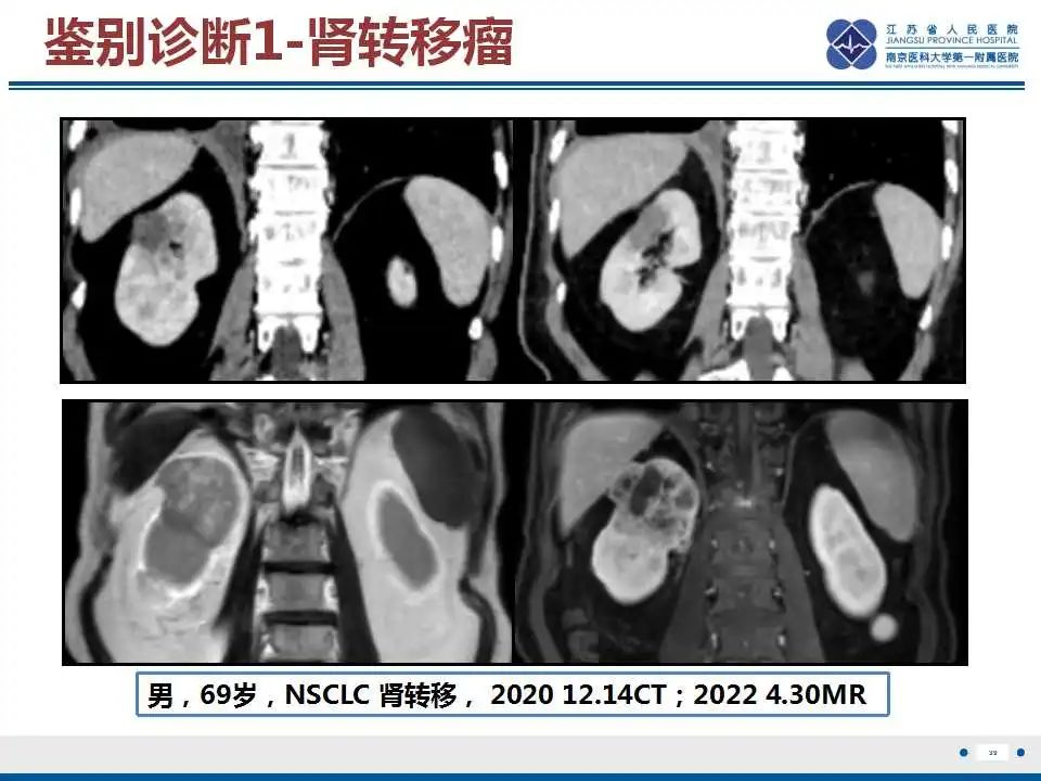 影像PPT - 【PPT】克唑替尼相关性肾囊肿-40