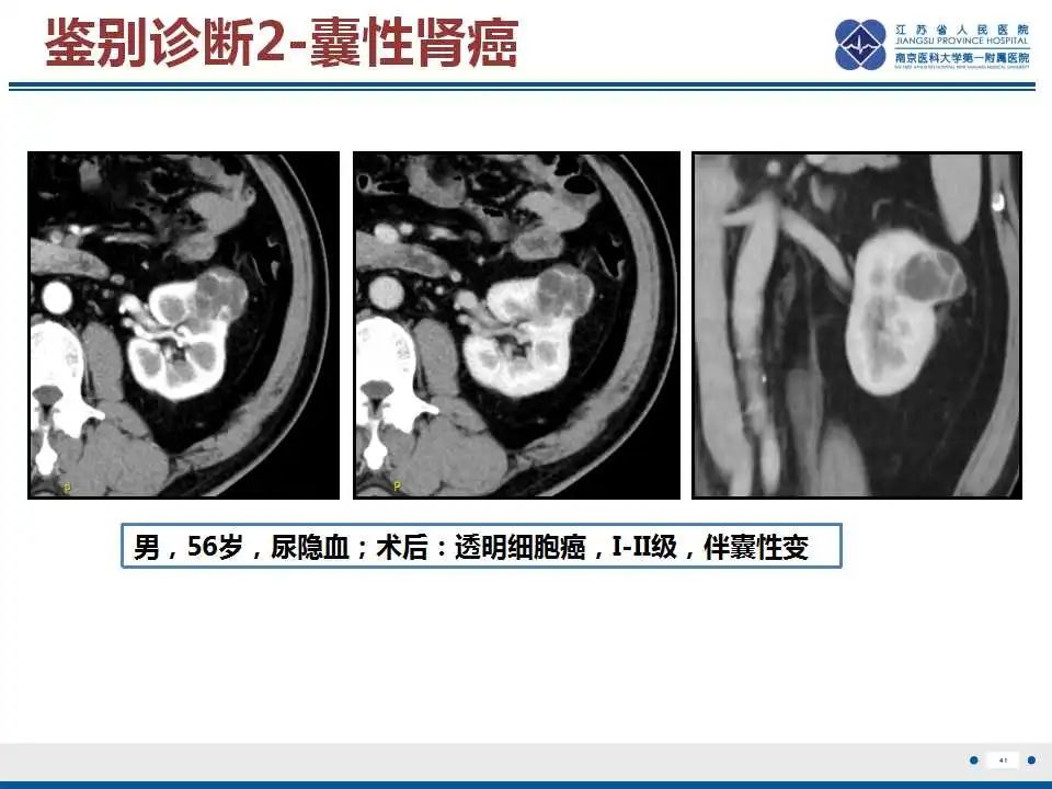 影像PPT - 【PPT】克唑替尼相关性肾囊肿-42