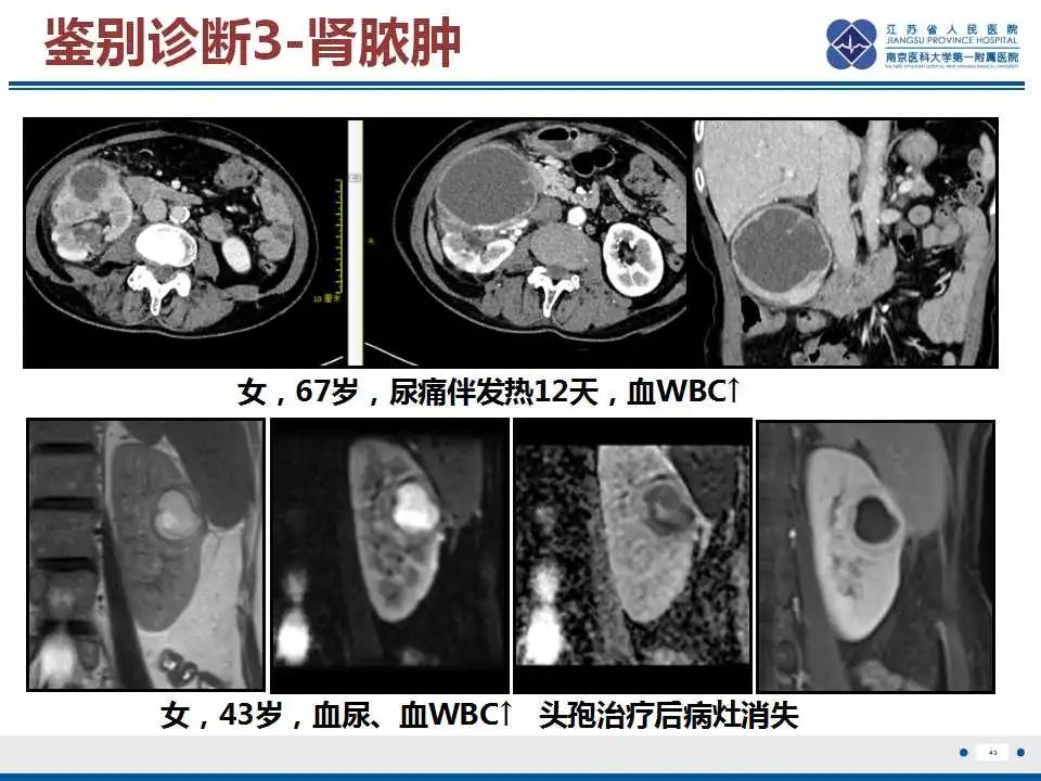 影像PPT - 【PPT】克唑替尼相关性肾囊肿-44