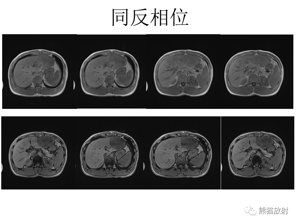 影像PPT - 【病例】肝细胞腺瘤2例MR影像-5
