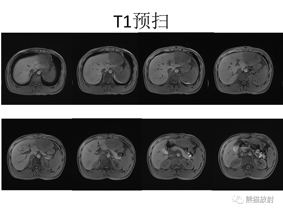 影像PPT - 【病例】肝细胞腺瘤2例MR影像-7