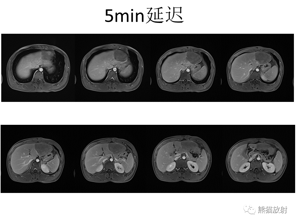 影像PPT - 【病例】肝细胞腺瘤2例MR影像-11