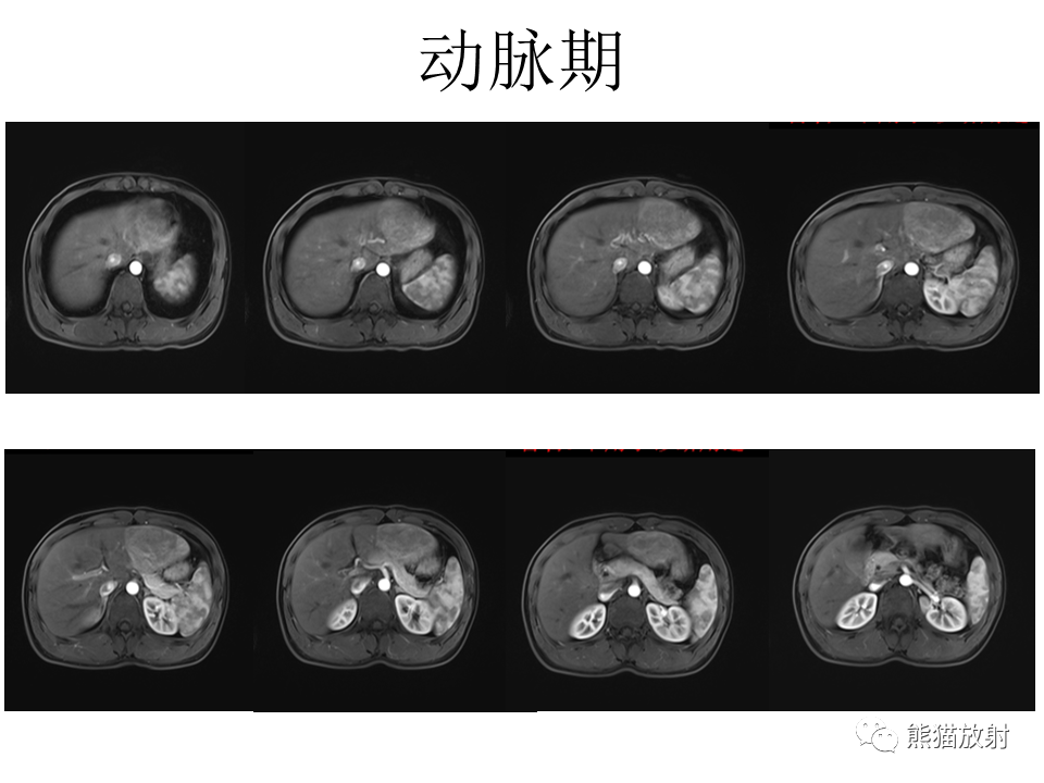 影像PPT - 【病例】肝细胞腺瘤2例MR影像-8