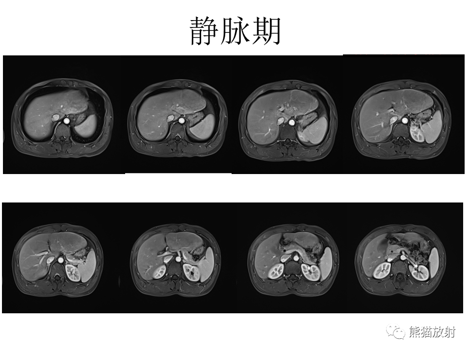 影像PPT - 【病例】肝细胞腺瘤2例MR影像-9