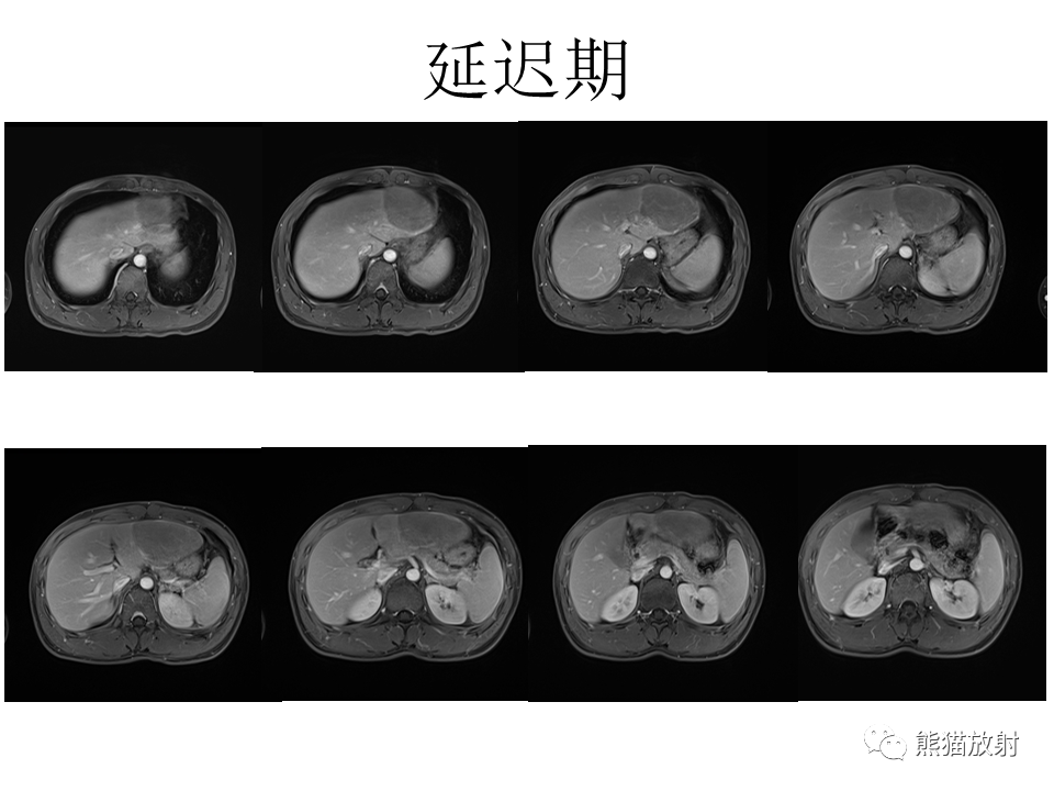 影像PPT - 【病例】肝细胞腺瘤2例MR影像-10