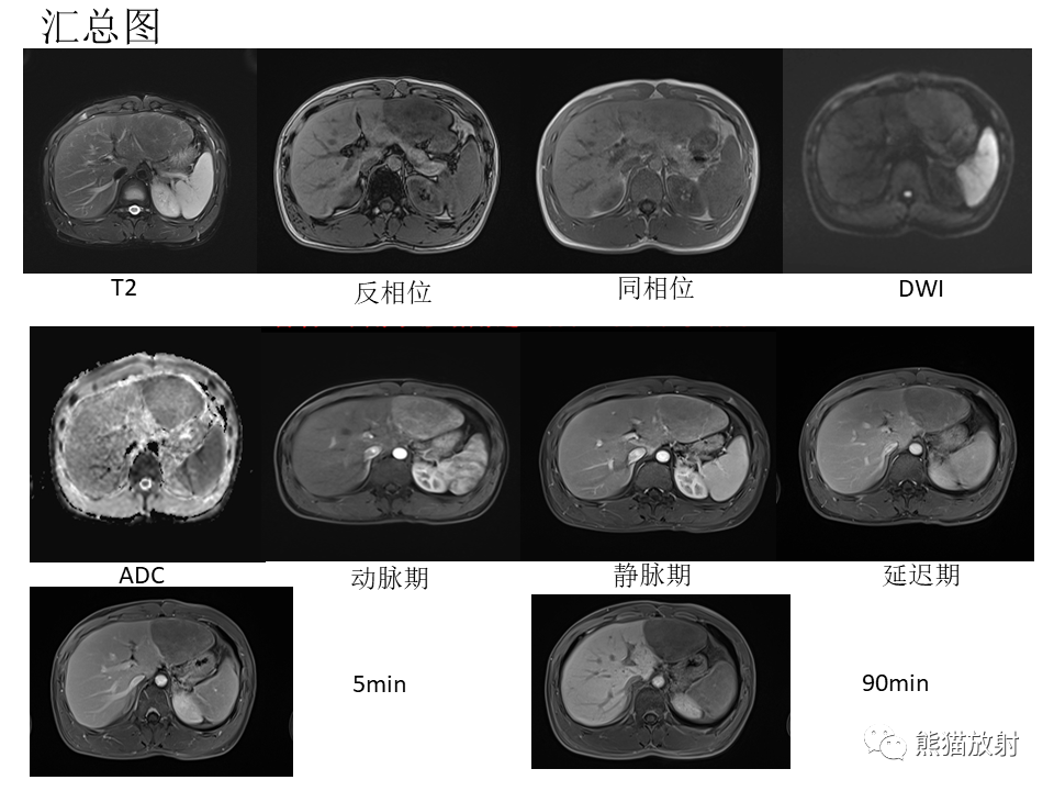 影像PPT - 【病例】肝细胞腺瘤2例MR影像-14