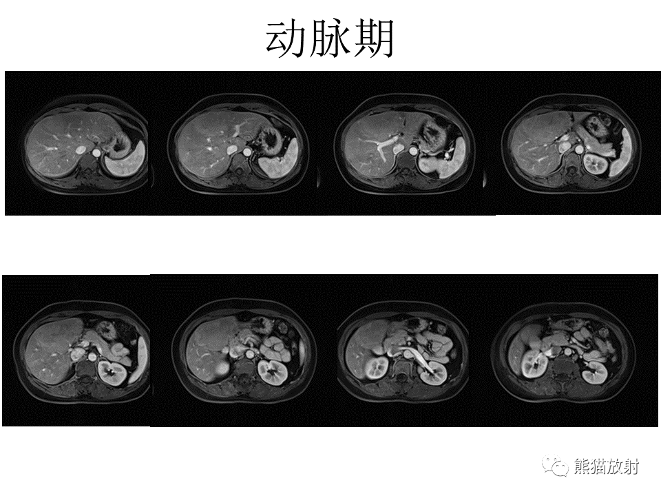 影像PPT - 【病例】肝细胞腺瘤2例MR影像-21