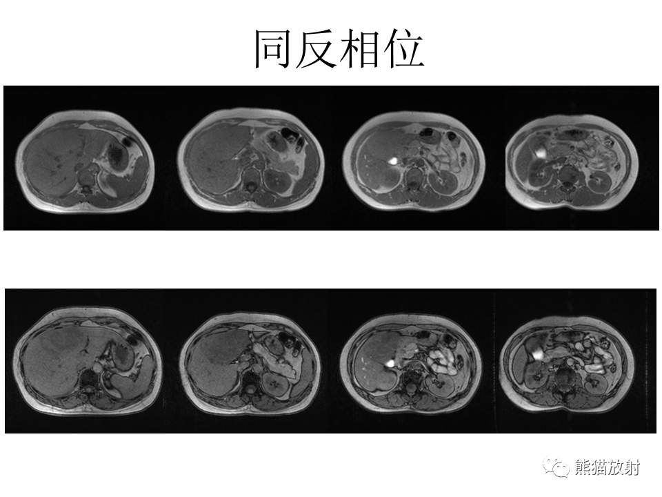 影像PPT - 【病例】肝细胞腺瘤2例MR影像-19