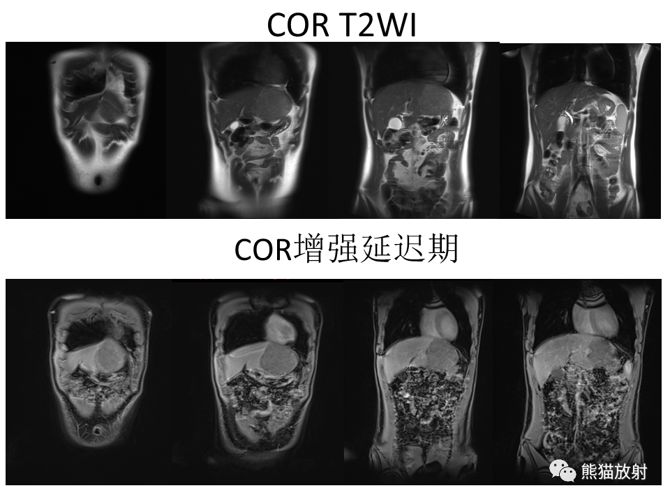 影像PPT - 【病例】肝细胞腺瘤2例MR影像-13