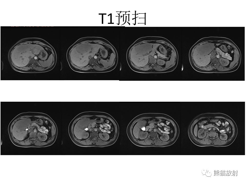 影像PPT - 【病例】肝细胞腺瘤2例MR影像-20