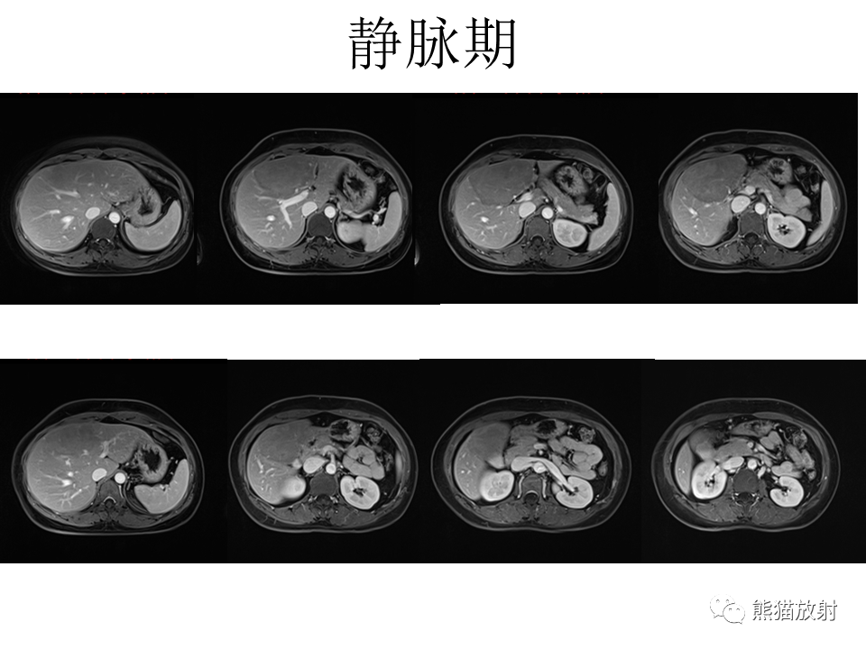 影像PPT - 【病例】肝细胞腺瘤2例MR影像-22