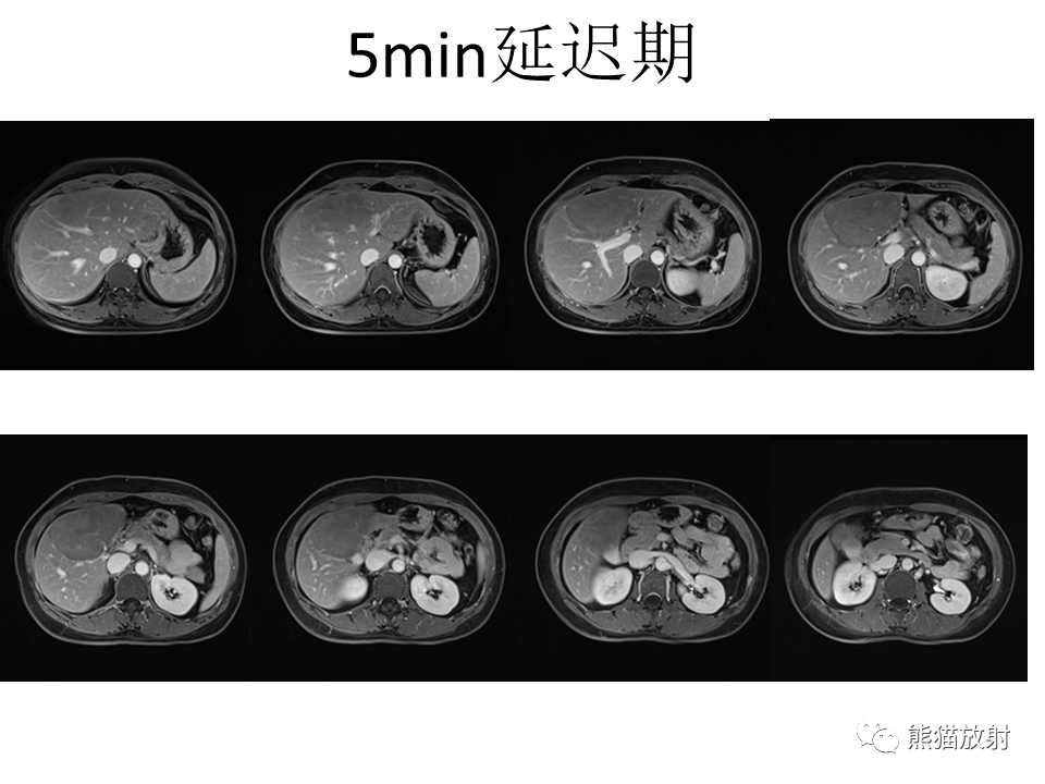 影像PPT - 【病例】肝细胞腺瘤2例MR影像-23